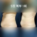 시리네일 - 부천시 원미구 | 천안 이중턱 팔뚝살 복부 허벅지 지방분해 다이어트 효과 후기 성분 주의 사항