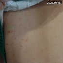더모멘타 | 물방울건선 완치 후기 / 모멘타 연고 쓰고도 재발했던 원인은? 원인에 따른 면역 치료로 리바운드 잡은...