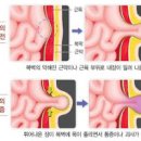 장이 꽉 막히는 장폐색 원인과 증상 : 치료 방법 이미지