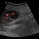 renal abscess 이미지