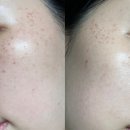 강남 피부과 &#39;블리스의원&#39; 악센토 레이저 주근깨 시술 리얼 후기!!