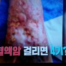 중년이 더 위험하다, 혈액암 이미지