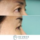 시원성형외과의원 | 611 뒤트임복원, 밑트임복원 2개월차 후기 : 뒤트임 후 발생한 과도한 모양변형을 개선 at. 시원성형외과