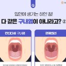 구내염 증상 및 구내염 빨리 낫는법 이미지