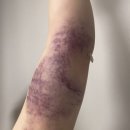 보라멍 | [팔/허벅지안쪽 람스 후기]1주차 멍, 통증 등(3~7일차)