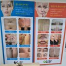 이수역 피부관리, 나디뷰티 :: 편평사마귀 플라즈마 제거 후기
