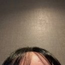 제일한의원 | [수원]한의원 수두 흉터 치료 새살침 3회차 후기 | 과정&amp;변화 공유