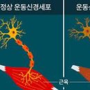 루게릭병 초기증상 루게릭병 증상 원인 검사 방법 근위축성측색경화증 초기증상 방법 이미지