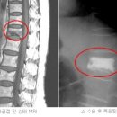 척추골절 및 탈구 이미지