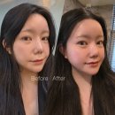논현골드 | 더록시에스테틱논현점 웨딩케어 후기, 예신케어로 받은 신부관리 리얼 변화