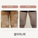 지에스바이오 | 남양주 비만관리 스키니바디 고주파 석션 등관리 후기 – 어깨 결림 풀리고 오십견에도 효과