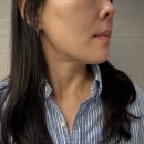 대지약국 | 거여피부과 전문의에게 받은 온다리프팅 내돈내산 후기(통증, 효과)