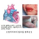 가와사키병 Kawasaki Disease과 이스피린 이미지