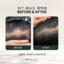 평택원형탈모 <임상사진> 원형탈모 6개월 재생관리 전후 후기입니다