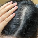 메디엑스퍼트 | 미녹시딜+엘크라넬+메디헤어+기타 탈모 보조영양제 4개월 후기 (듀크레이 네옵타이드 엑스퍼트는 미사용)
