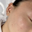 정블리뷰티 - 남구 | [포항 쌍사 메디컬스킨케어 전문점] ‘정블리뷰티’ 트러블 민감피부 사과필 후기