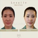 레젤스킨 & 바디 | 오늘도 레젤스킨&바디에서 해운대리프팅 받고 온 직장인 일기 한 줄