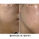 마리뷰티 | 부산 동래구 여드름 피부관리 추천 마리뷰티에서 플라즈마 받은 후기