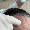디제이코인 | [뇌수막종] 수술 후 6-7일차
