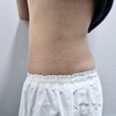 렌 | 구로디지털단지 바이온다 리프팅 살롱드세이렌 산후복부관리 후기