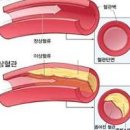 고지혈증 증상 원인 알아보기! 이미지