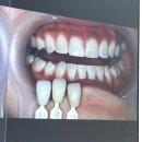 좋은얼굴신종연치과의원 | 치아미백 신사역 레브치과 원데이 치아미백 내돈내산 후기