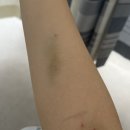 인천사랑병원 | 인천사랑병원 맹장수술 일기 후기, 증상, 입원 준비물 (급성 충수염)