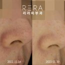 엑셀브이의원 | 청담엑셀브이 주사피부염 치료 후기 (브이빔과의 차이점)