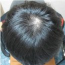 배원식한의원 | 남자정수리탈모 치료후기