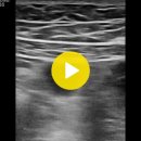small bowel obstruction or paralytic ileus(소장 폐쇄 또는 장마비) 이미지