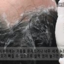 모발이식 후 샴푸는 언제 할까요? 이미지