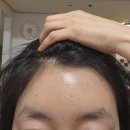 강남역 신논현역 이마거상 2개월 통증 붓기 흉터등등 후기