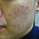 차오름한의원 | 리유한의원 강남본점 여드름흉터 차오름침 비용 내돈내산 후기입니다.