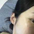 천안 불당동 피부과 점 제거 개당 500원 두 달 지난 후기 &amp; 성성동 피부과에서 2차 점 제거 후기
