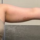 (주)베트라 | 팔 지방추출주사 2주차 :: 관리루틴, 멍 빨리 빼는법, Before&amp;After