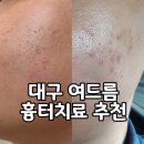 씨제이올리브영(주)대구동성로점 | 대구여드름흉터치료 내돈내산 후기｜동성로한의원 1회차