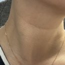 아이즈 | 올피채 강남역 피부과 목주름 리프팅 솔직후기｜튠아이즈+스킨보톡스로 달라진 넥라인