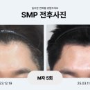 유현초등학교 | 김포두피문신 M자 정수리 헤어라인 탈모커버 잘하는 곳 찾는다면?