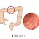 장의 게실성 질환[intestinal diverticulum] 이미지