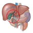 슬기로운 의사생활에서 익순이가 걸렸었던 선천적 담도폐쇄증이 얼마나 위험한병인가 이미지