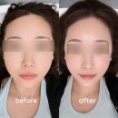 남부의원 | 연세라미슈의원 쿨페이즈 600샷 받고 온 후기 통증 부담 적었던 리프팅