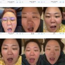 세연내과의원 | 안면마비 벨마비 구안와사 치료후기