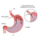 속쓰림 = 위산이 너무 많음? 이미지