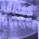 강앤이치과의원 | 천안 신부동 사랑니 발치 후기 | 신경 가까운 매복사랑니, 턱앤사랑니치과에서 당일에 뺐어요!