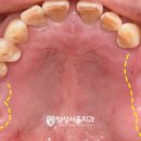 새(고경) | 밥 먹는 게 힘들어요&#34; 단구동 치과 구치부 재건 통한 교합고경 회복 방법 + 앞니 벌어짐 레진 치료까지