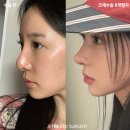 제이티플랜 | 비주 처진 코, 긴코 재수술! 수술 3일차~8개월 후기