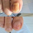 진영메디칼 | 김해 발톱무좀 고민없이 선택한 곳