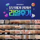 아이콘성형외과의원 | 문신제거 33,000원 롤리팝성형외과 피코슈어 시술전후 리얼후기