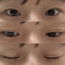 쌍꺼풀 재수술 후기2: 병원 상담부터 수술 1w