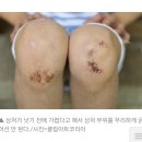 상처 낮기전에 가려운 이유 이미지